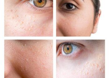 Ilustrasi milia dan jerawat. (Foto: Pexels)