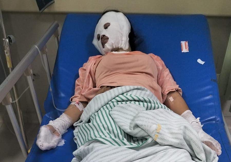 Ibu-ibu terbakar saat hajatan.