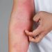 Dampak Bahaya Polusi Udara pada Kulit, Ini Tips Menangkal dari Ahli Dermatologi Unair 9 Polusi udara.