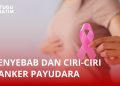 Penyebab dan Ciri-ciri Kanker Payudara, Data WHO: Diderita 2,3 Juta Orang di Dunia