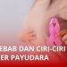 Penyebab dan Ciri-ciri Kanker Payudara, Data WHO: Diderita 2,3 Juta Orang di Dunia
