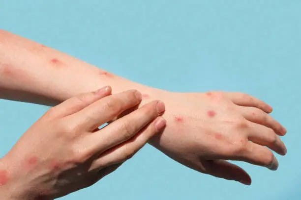 Surabaya Nol Kasus Mpox, Dinkes Tetap Perketat Pelabuhan dan Bandara 1 Kasus Mpox.
