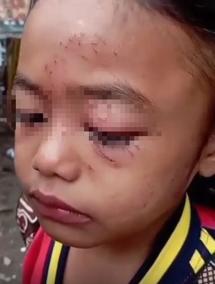 Bocah SD di Jember korban kekerasan.
