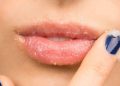 Bibir Kering dan Pecah-Pecah